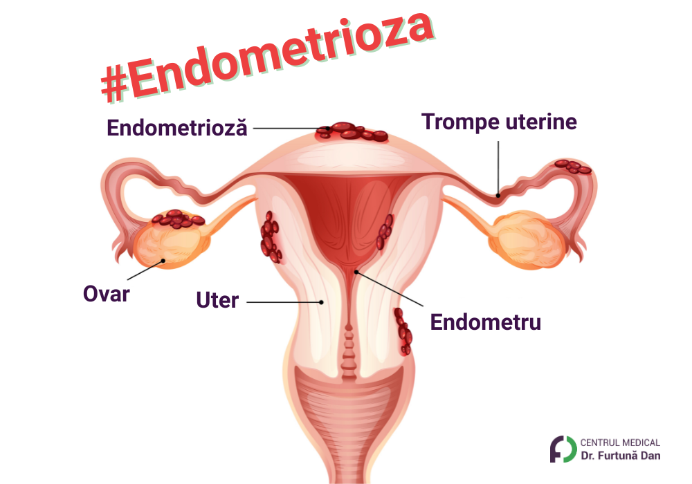 Endometrioza – schemă a uterului, trompelor uterine și a țesutului endometrial ectopic
